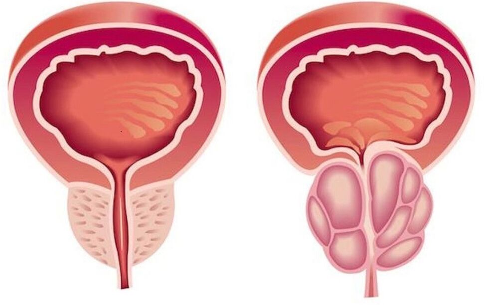 البروستاتا السليمة والملتهبة مع التهاب البروستاتا
